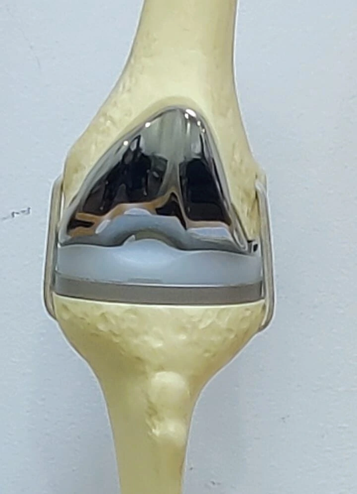 knee replacement surgery by dr chethan